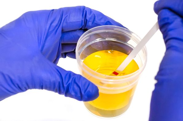 UACR (Urine ACR) - Redcliff Labs
