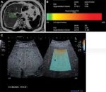 Liver Elastography / Liver Fat Quantification https://medigolife.com