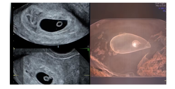 Transvaginal Ultrasound (TVS) - Meraj and Salman Diagnostic Centre